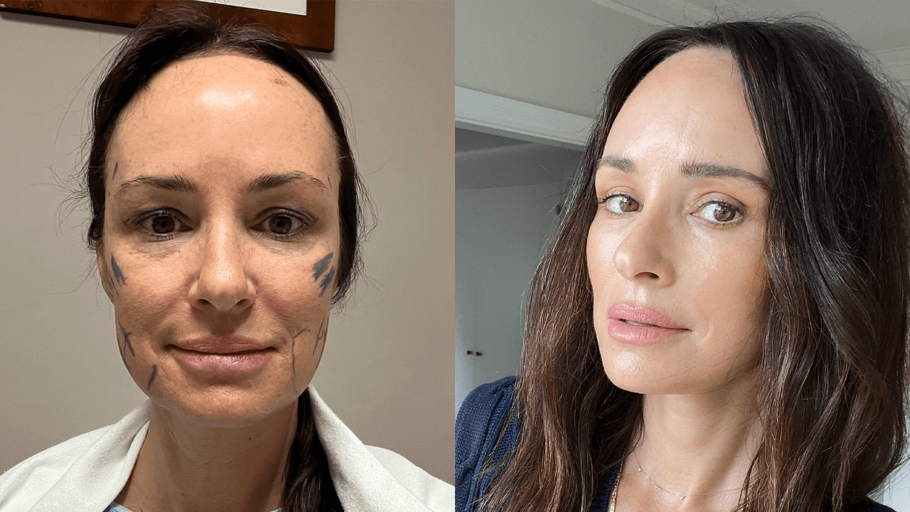 Catt Sadler, bed, post-opp, facelift, bandages, pillow